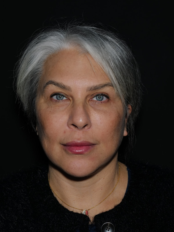 Lip Lift Before & After Photo