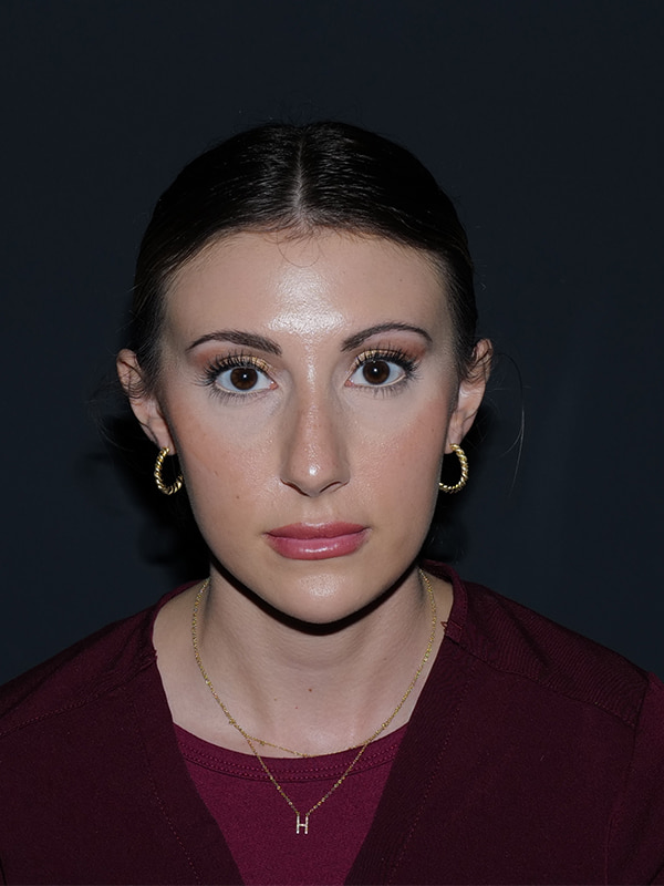 Rhinoplasty Before & After Photo