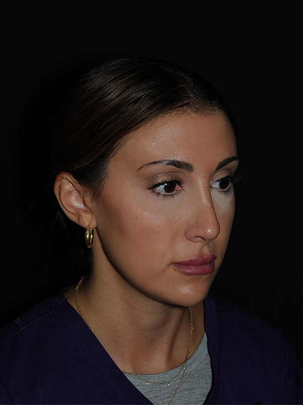 Rhinoplasty Before & After Photo