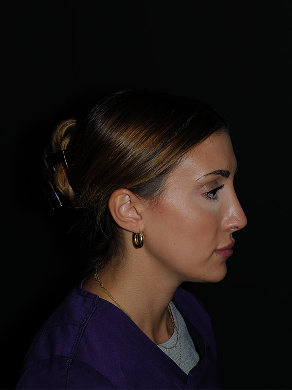 Rhinoplasty Before & After Photo