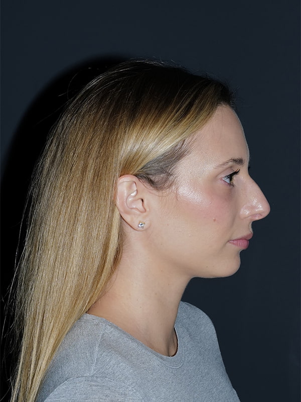 Rhinoplasty Before & After Photo