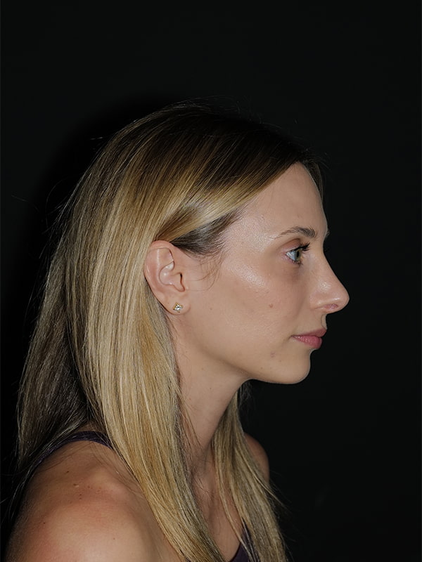 Rhinoplasty Before & After Photo