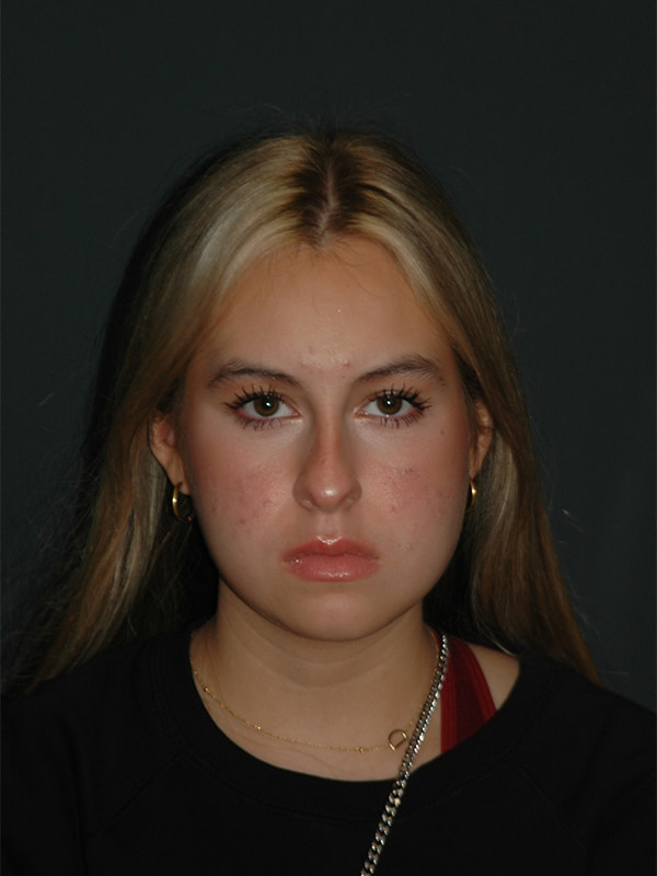 Rhinoplasty Before & After Photo