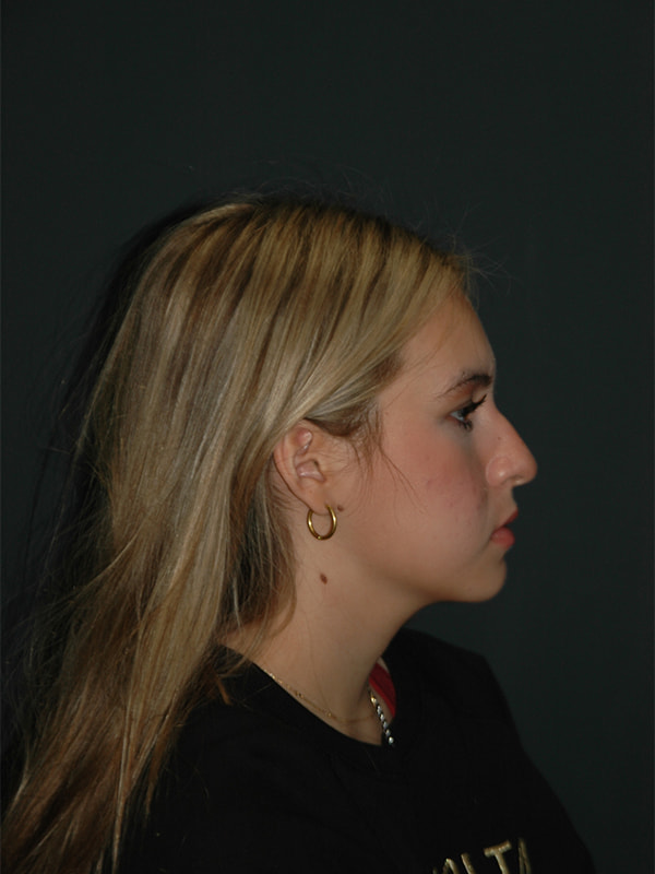 Rhinoplasty Before & After Photo