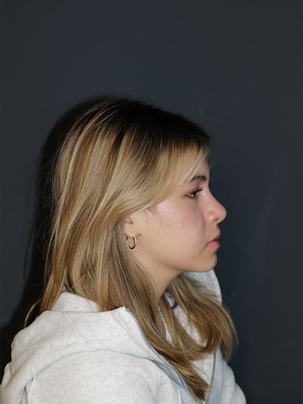 Rhinoplasty Before & After Photo