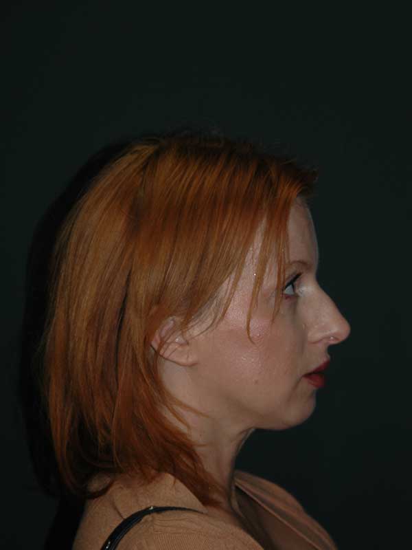 Rhinoplasty Before & After Photo