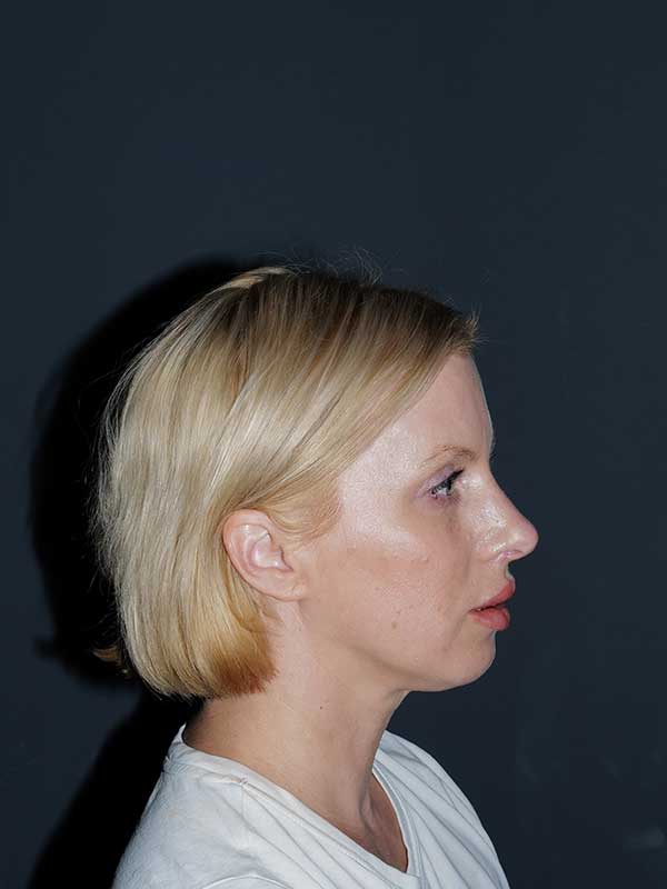 Rhinoplasty Before & After Photo