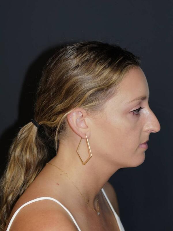 Rhinoplasty Before & After Photo