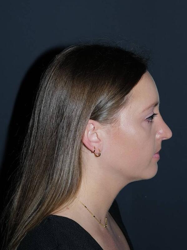 Rhinoplasty Before & After Photo