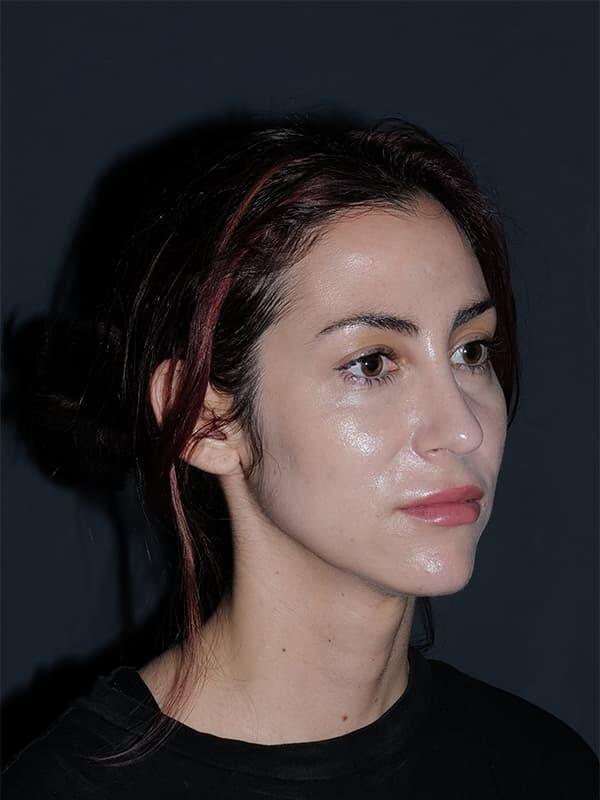 Rhinoplasty Before & After Photo