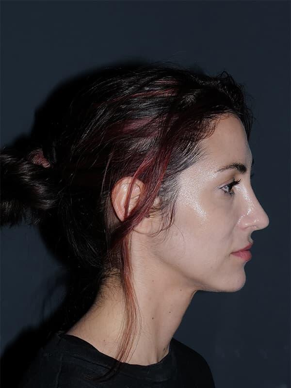 Rhinoplasty Before & After Photo