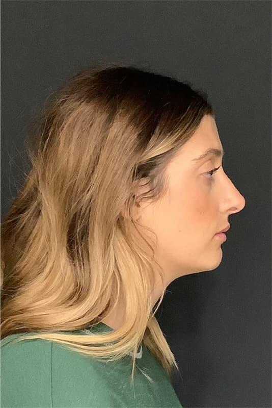 Rhinoplasty Before & After Photo