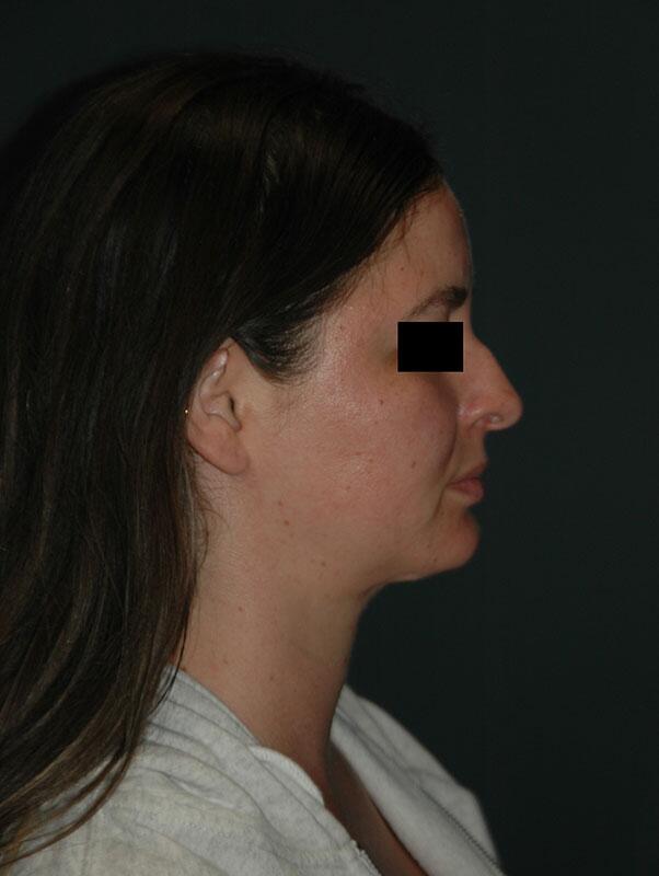 Rhinoplasty Before & After Photo