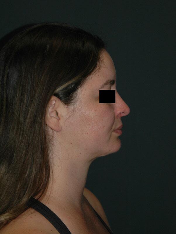 Rhinoplasty Before & After Photo