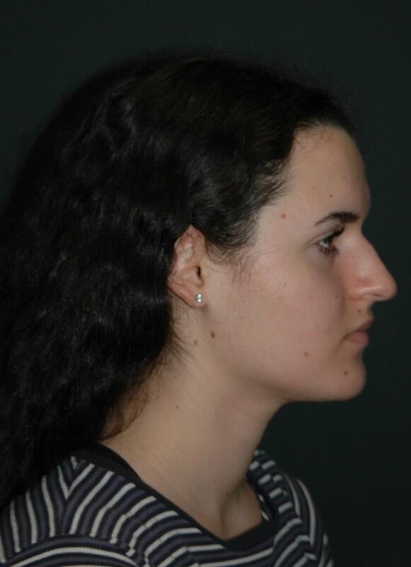 Rhinoplasty Before & After Photo