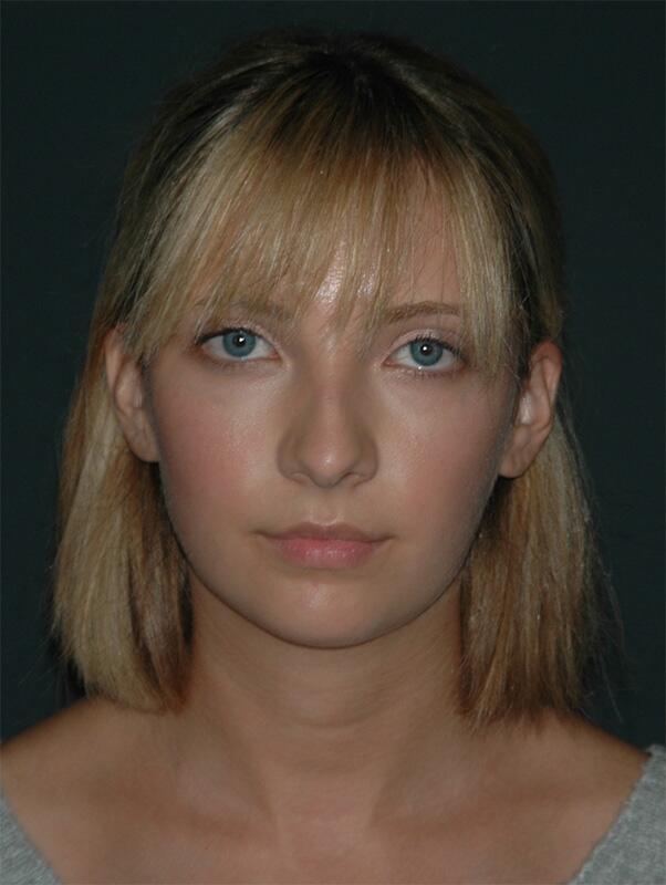 Rhinoplasty Before & After Photo