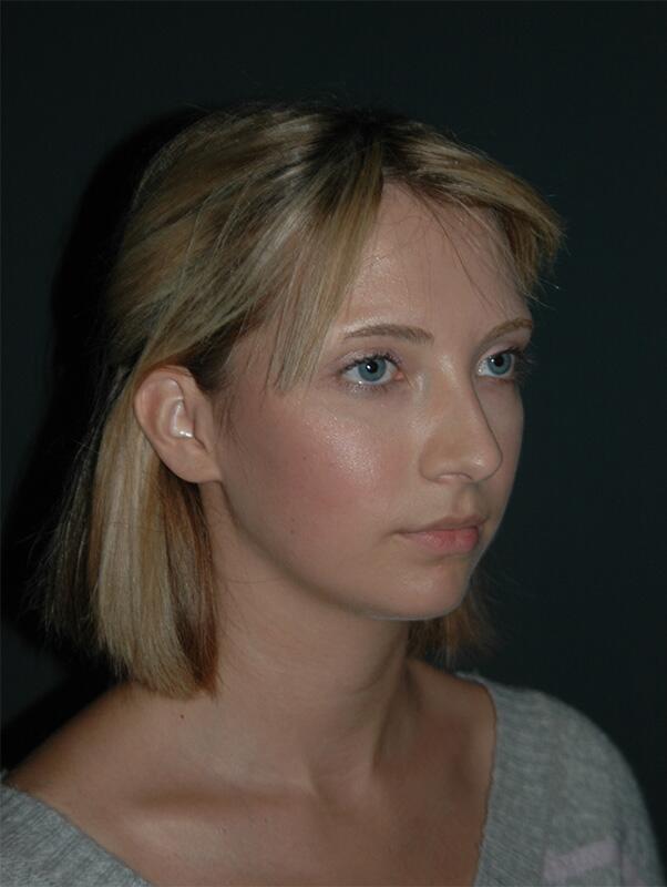 Rhinoplasty Before & After Photo