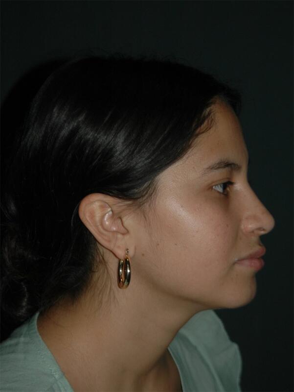 Rhinoplasty Before & After Photo