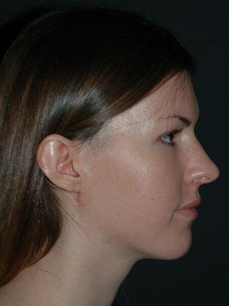 Rhinoplasty Before & After Photo