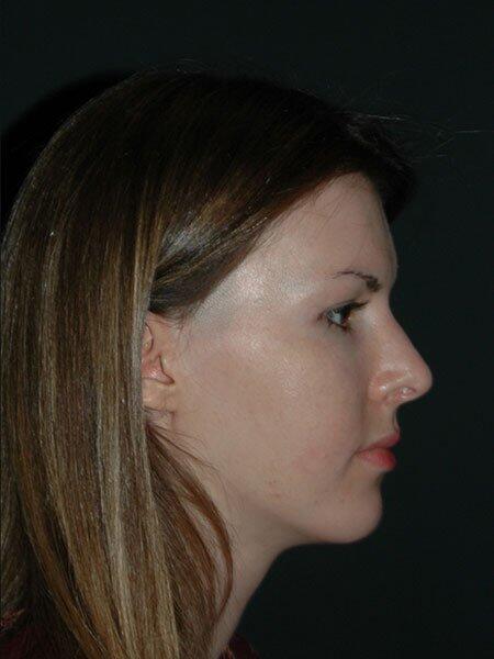 Rhinoplasty Before & After Photo