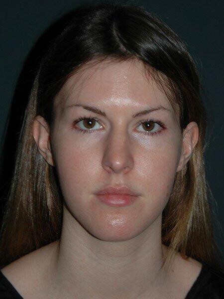 Rhinoplasty Before & After Photo