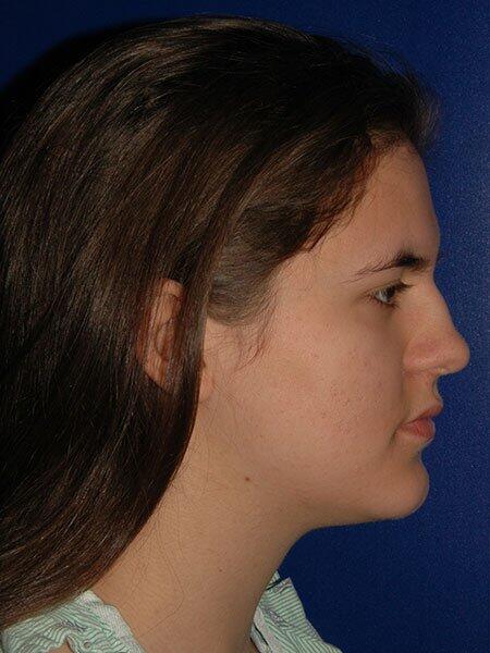 Rhinoplasty Before & After Photo