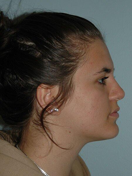 Rhinoplasty Before & After Photo