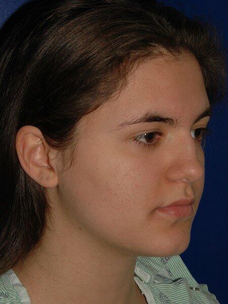 Rhinoplasty Before & After Photo