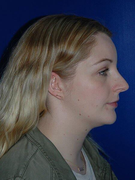 Rhinoplasty Before & After Photo