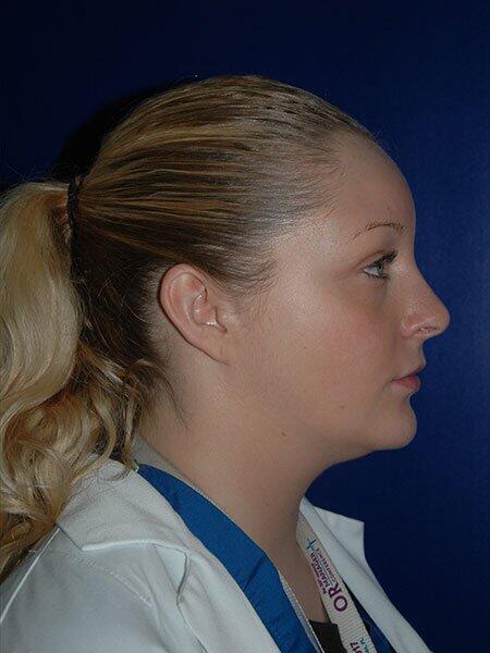 Rhinoplasty Before & After Photo