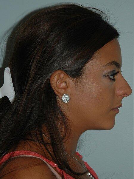 Rhinoplasty Before & After Photo