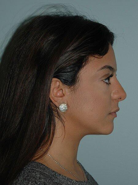 Rhinoplasty Before & After Photo