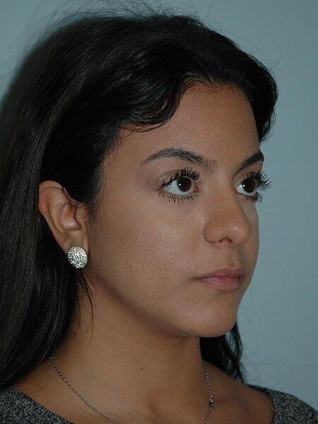 Rhinoplasty Before & After Photo