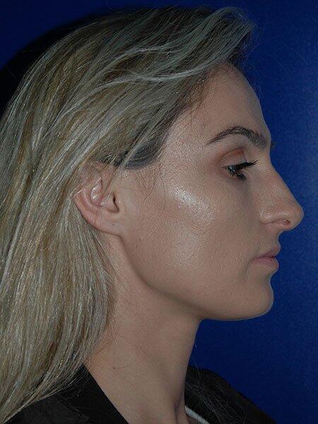 Rhinoplasty Before & After Photo