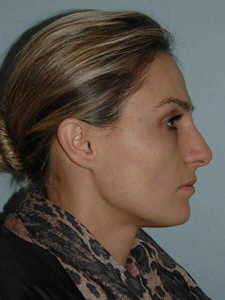 Rhinoplasty Before & After Photo