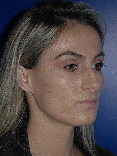 Rhinoplasty Before & After Photo