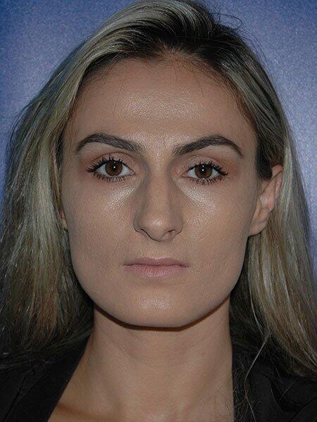 Rhinoplasty Before & After Photo