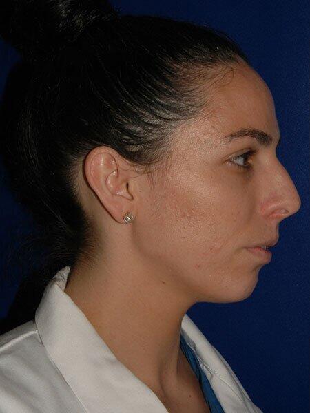 Rhinoplasty Before & After Photo