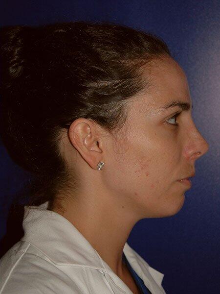 Rhinoplasty Before & After Photo