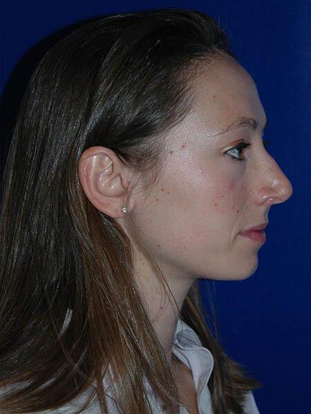 Rhinoplasty Before & After Photo