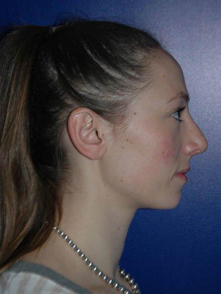 Rhinoplasty Before & After Photo