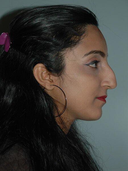 Rhinoplasty Before & After Photo