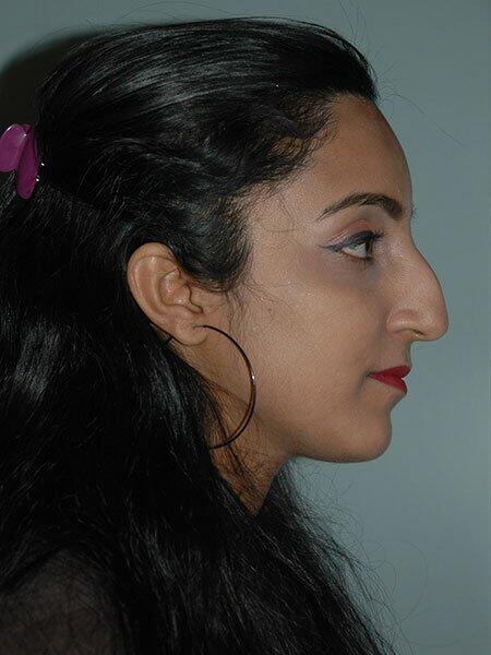 Rhinoplasty Before & After Photo