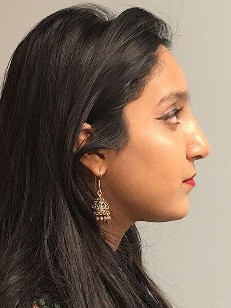 Rhinoplasty Before & After Photo